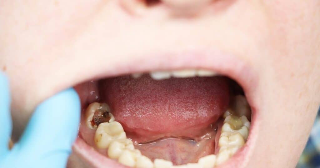 cavities & teeth whitening