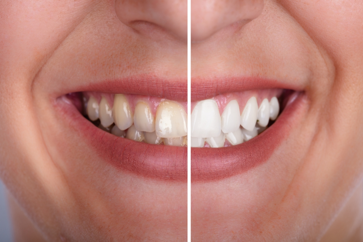 Featured image for “Professional vs. Over-the-Counter: Which Teeth Whitening Method Works Best for Your Smile in Glen Allen?”