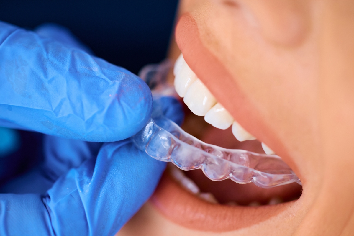 Featured image for “How Invisalign Helps Straighten Your Teeth”