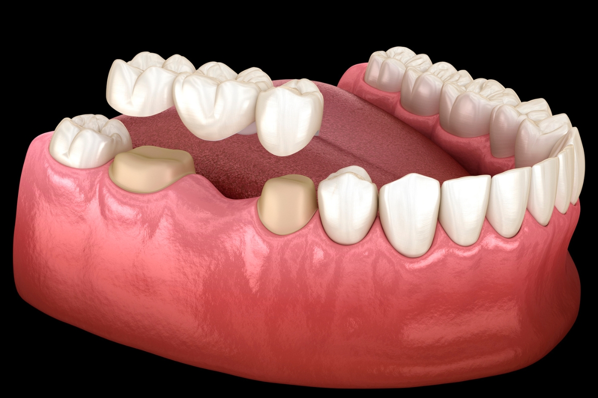 Featured image for “Why Dental Crowns Are Essential for Stronger Teeth and a Better Smile”