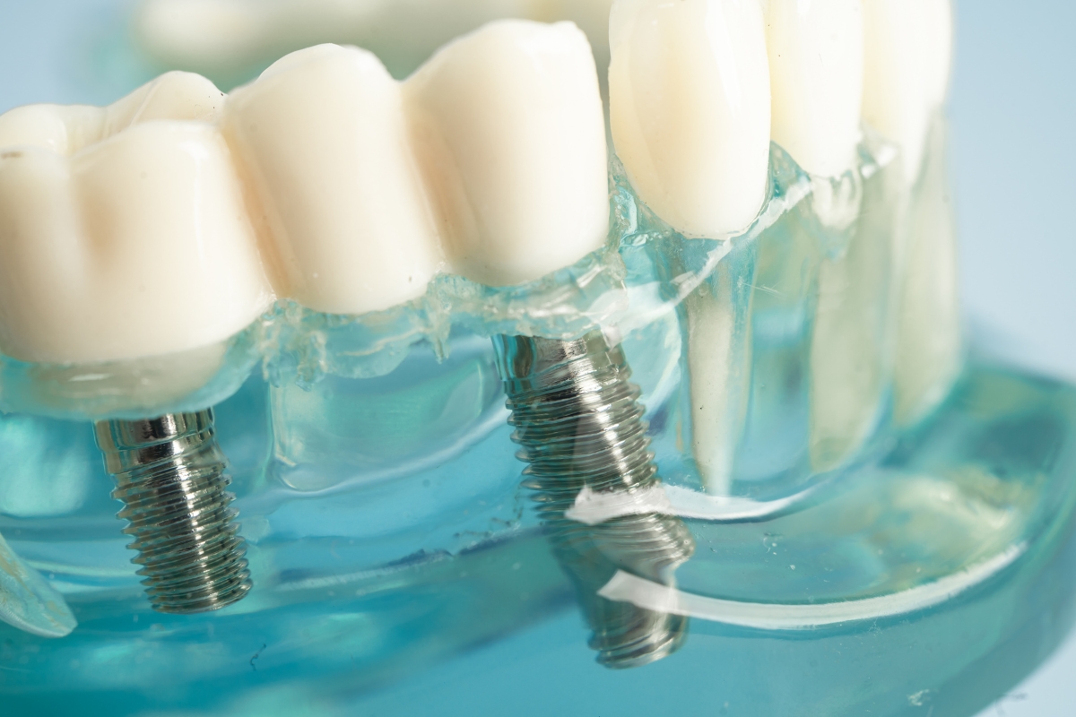 Featured image for “Choosing Between Dental Implants and Bridges: What You Need to Know”