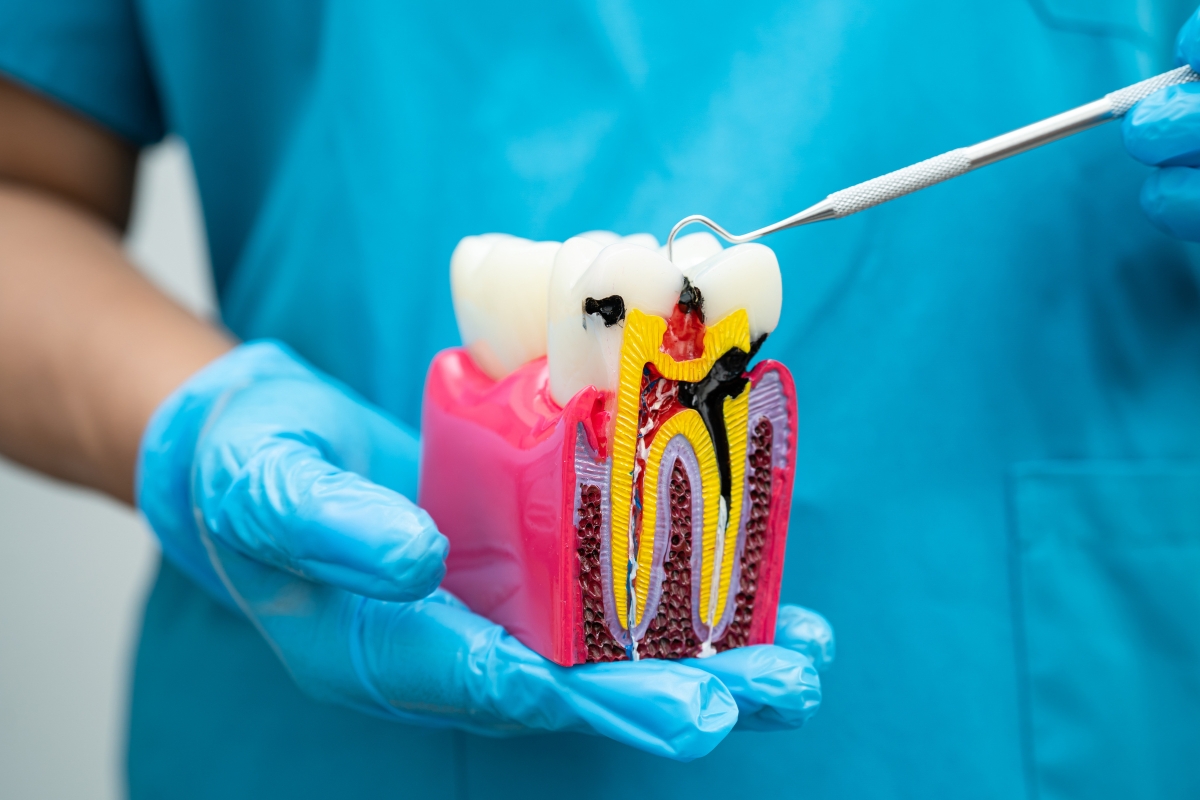 Featured image for “Cracked Tooth or Infection: When Root Canal Treatment Is Needed”